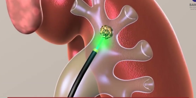 SANKO Üniversitesi Hastanesi'nde böbrek taşı tedavisinde Thulium Fiber Lazer Cihazı kullanılmaktadır