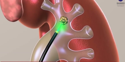 SANKO Üniversitesi Hastanesi'nde böbrek taşı tedavisinde Thulium Fiber Lazer Cihazı kullanılmaktadır